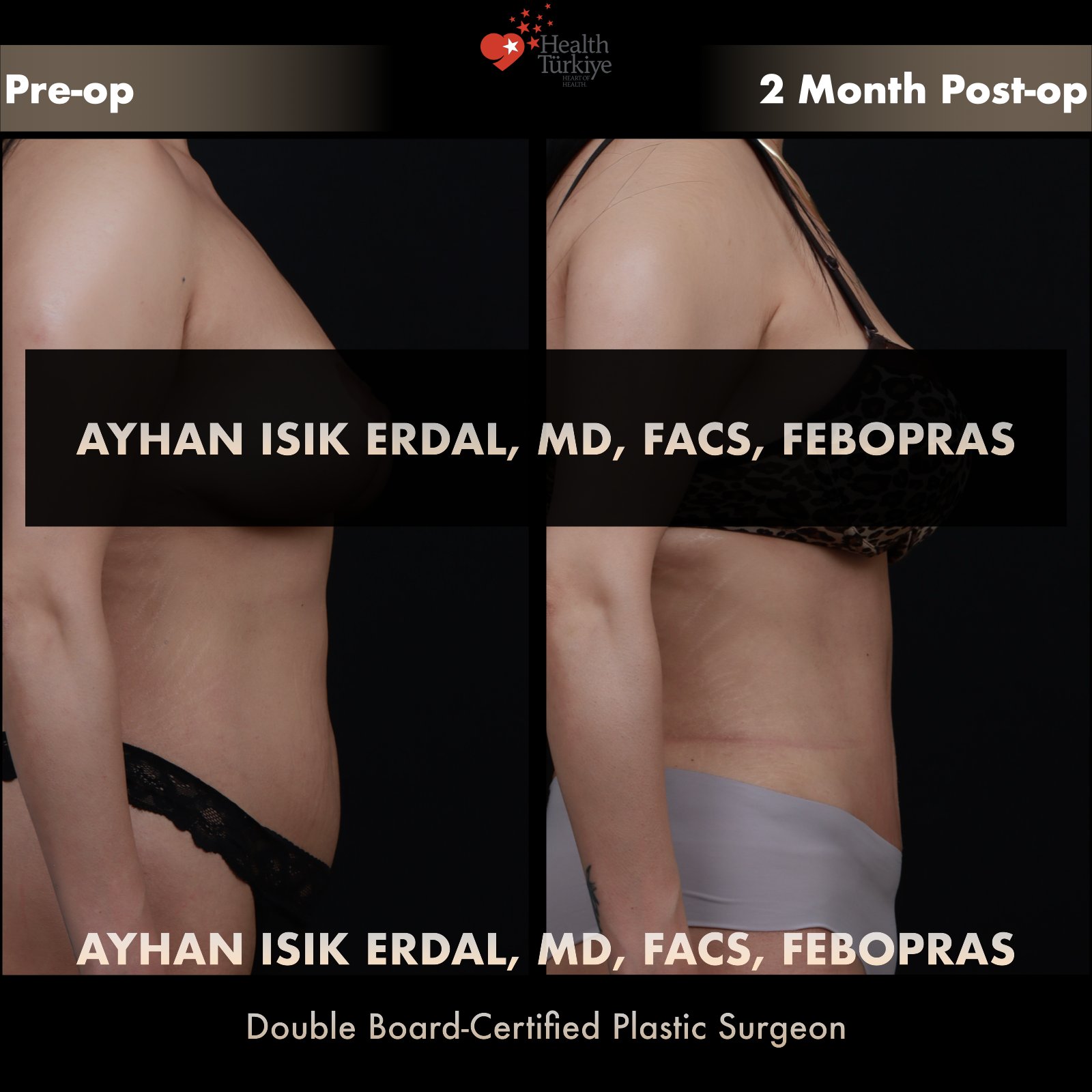 Standard abdominoplasty — lateral view, pre-operative vs 2 months post-operative comparison by Dr. Ayhan Işık Erdal