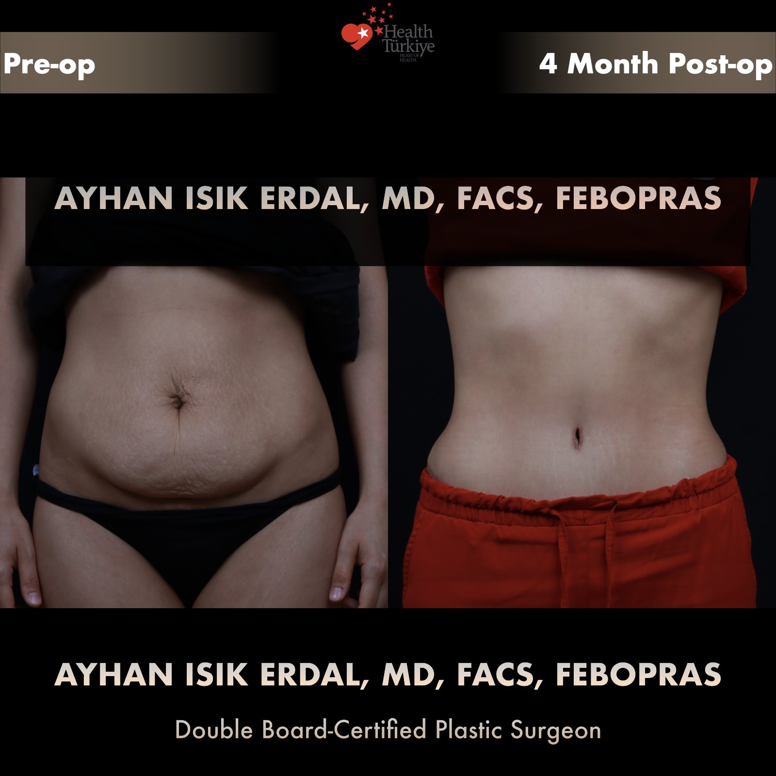 Post-pregnancy tummy tuck with stretch mark removal — frontal view, pre-operative vs 4 months post-operative comparison by Dr. Ayhan Işık Erdal