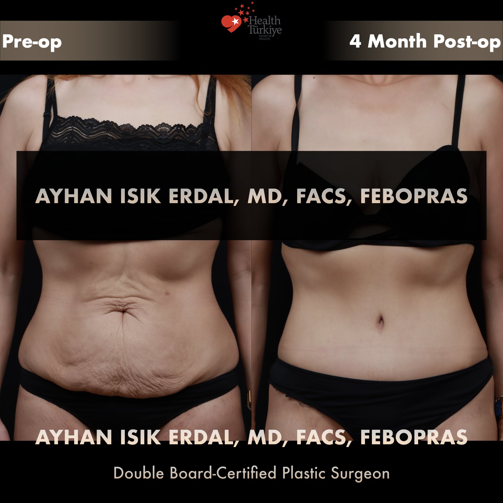 Standard abdominoplasty with significant skin laxity — frontal view, pre-operative vs 4 months post-operative comparison by Dr. Ayhan Işık Erdal