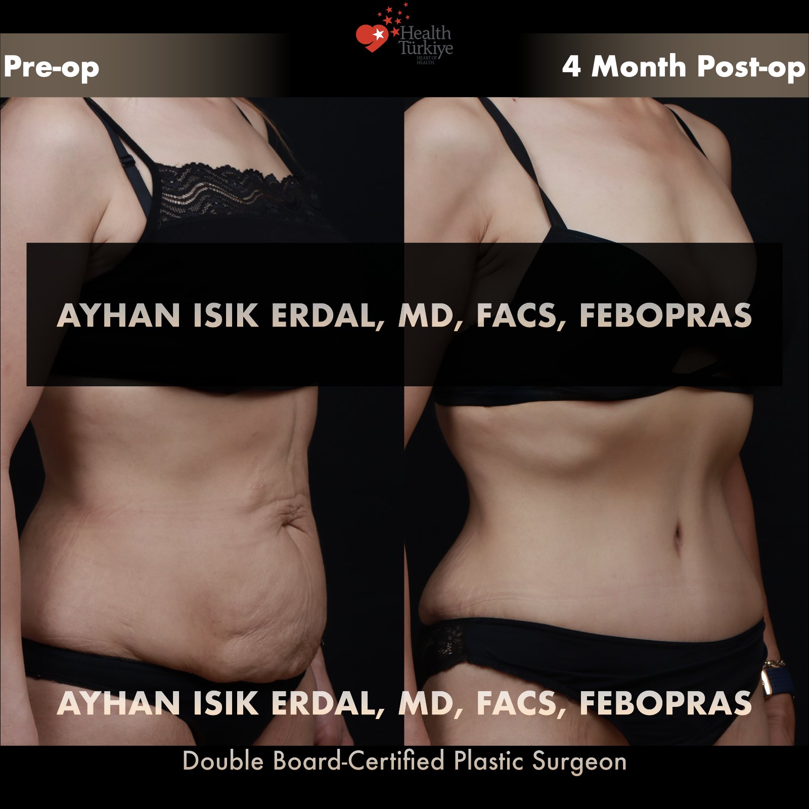 Standard abdominoplasty with significant skin laxity — oblique view, pre-operative vs 4 months post-operative comparison by Dr. Ayhan Işık Erdal